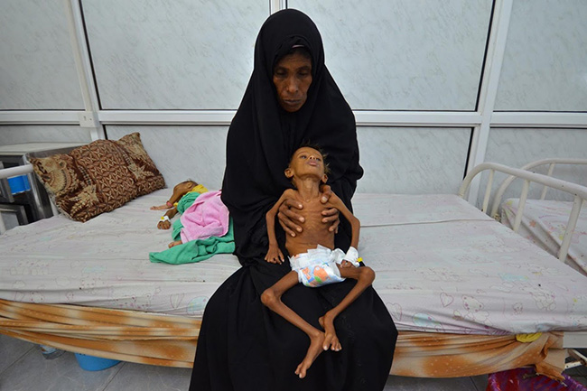Ám ảnh những đứa trẻ “da bọc xương” tại vùng chiến sự Yemen ảnh 3